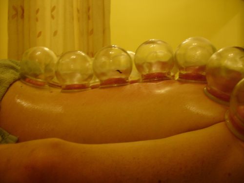 cupping_2